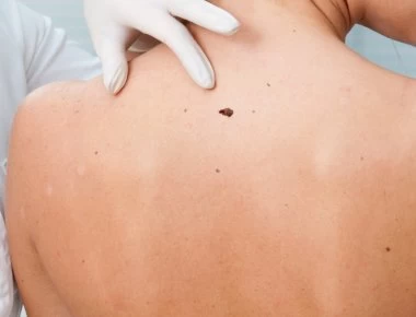 Ελιές στο δέρμα: Πώς θα καταλάβετε αν κάποιες είναι καρκίνος